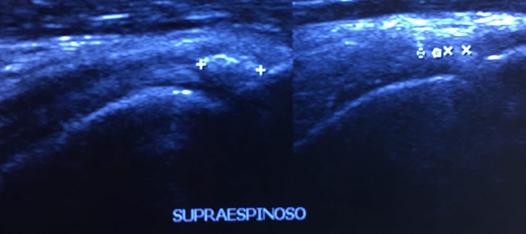 Tendinitis calcificante supraespinoso